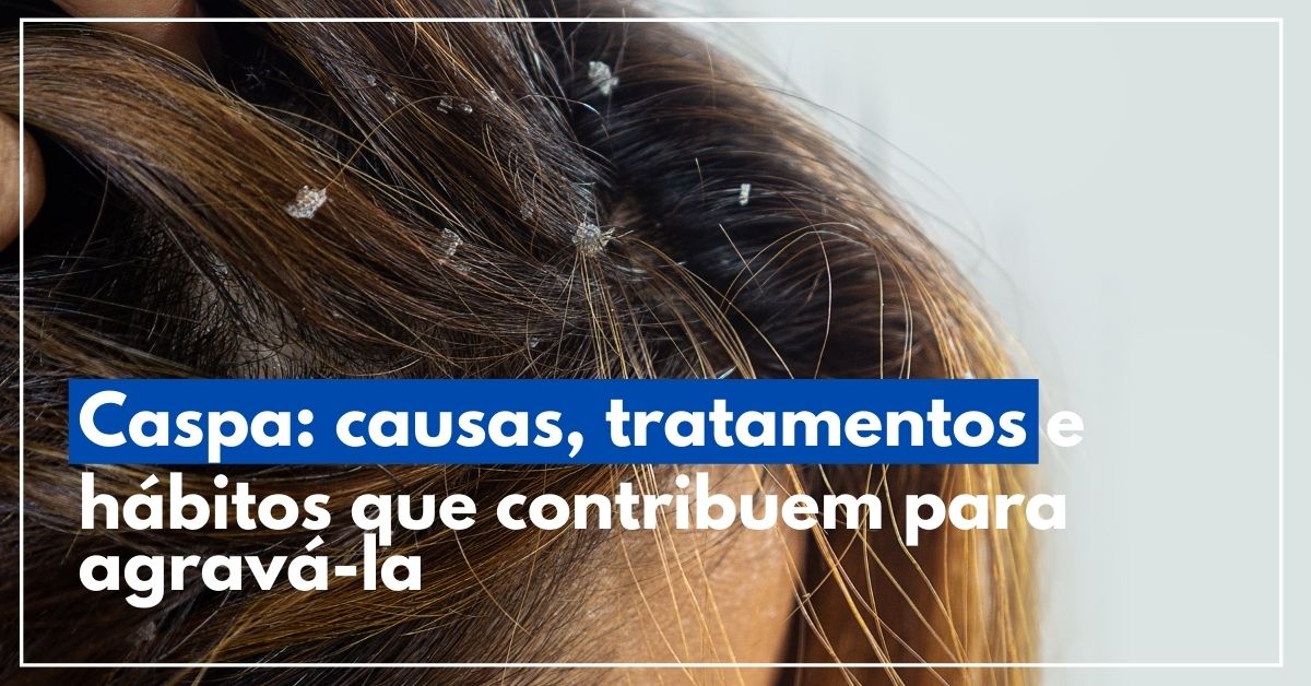 Caspa: causas, tratamentos e hábitos que contribuem para agravá-la
