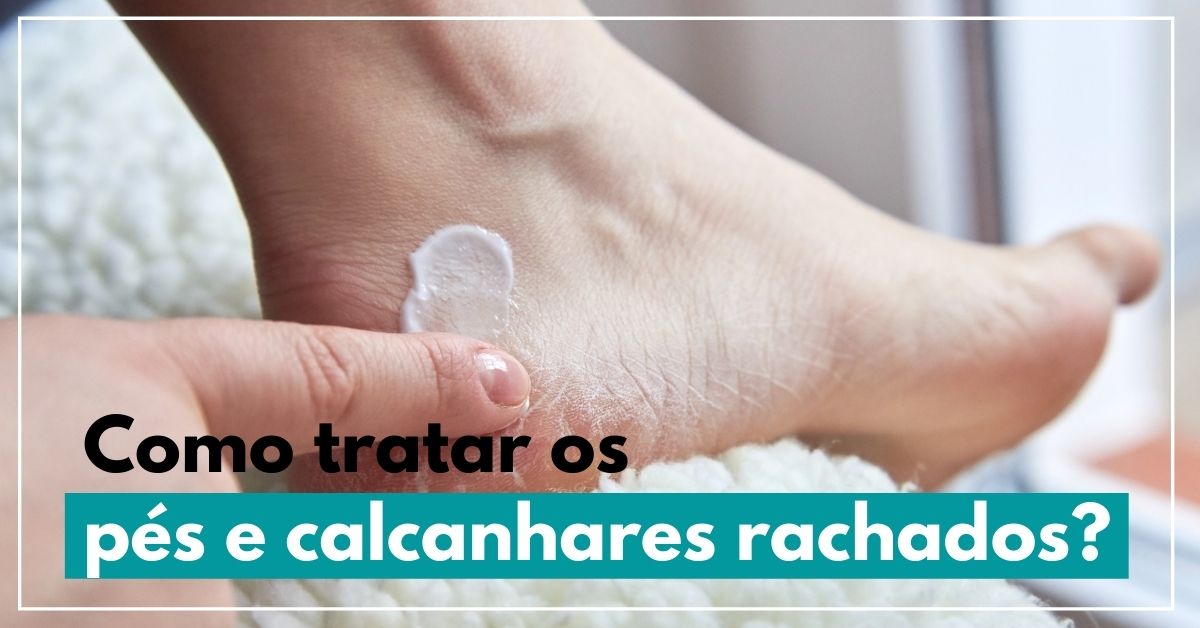 Como tratar os pés e calcanhares rachados?