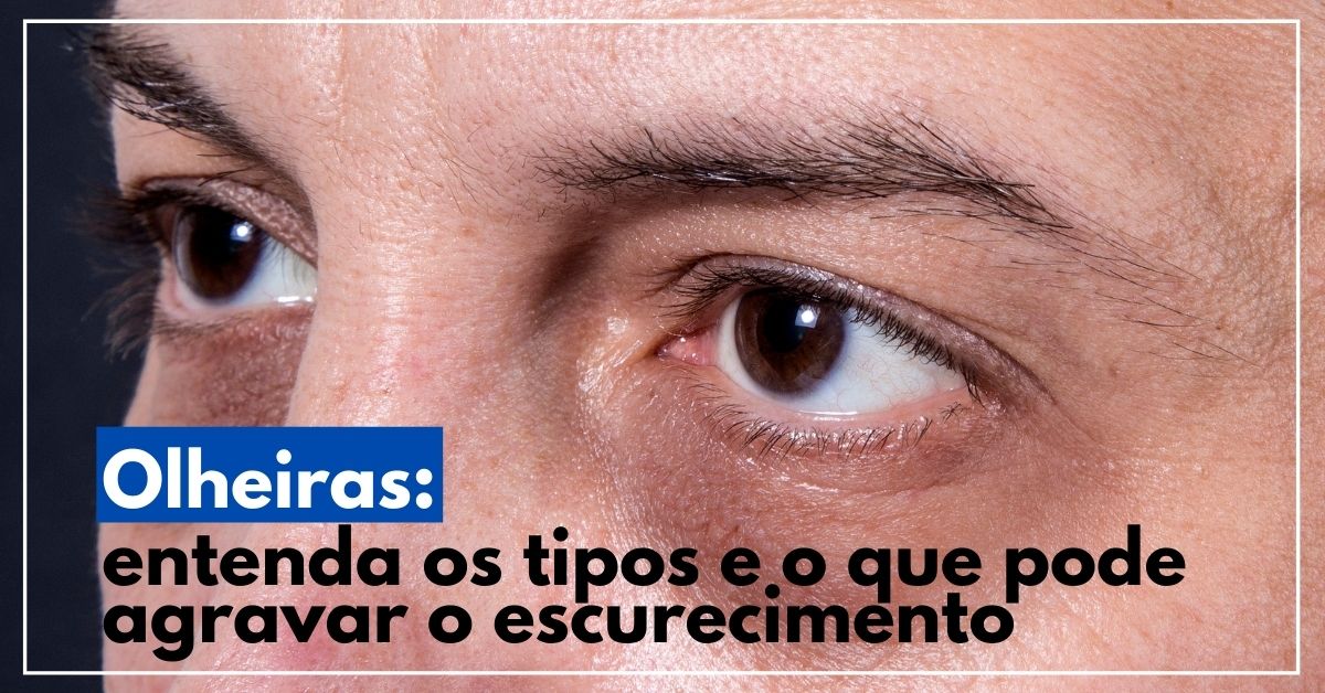 Olheiras: entenda os tipos e o que pode agravar o escurecimento