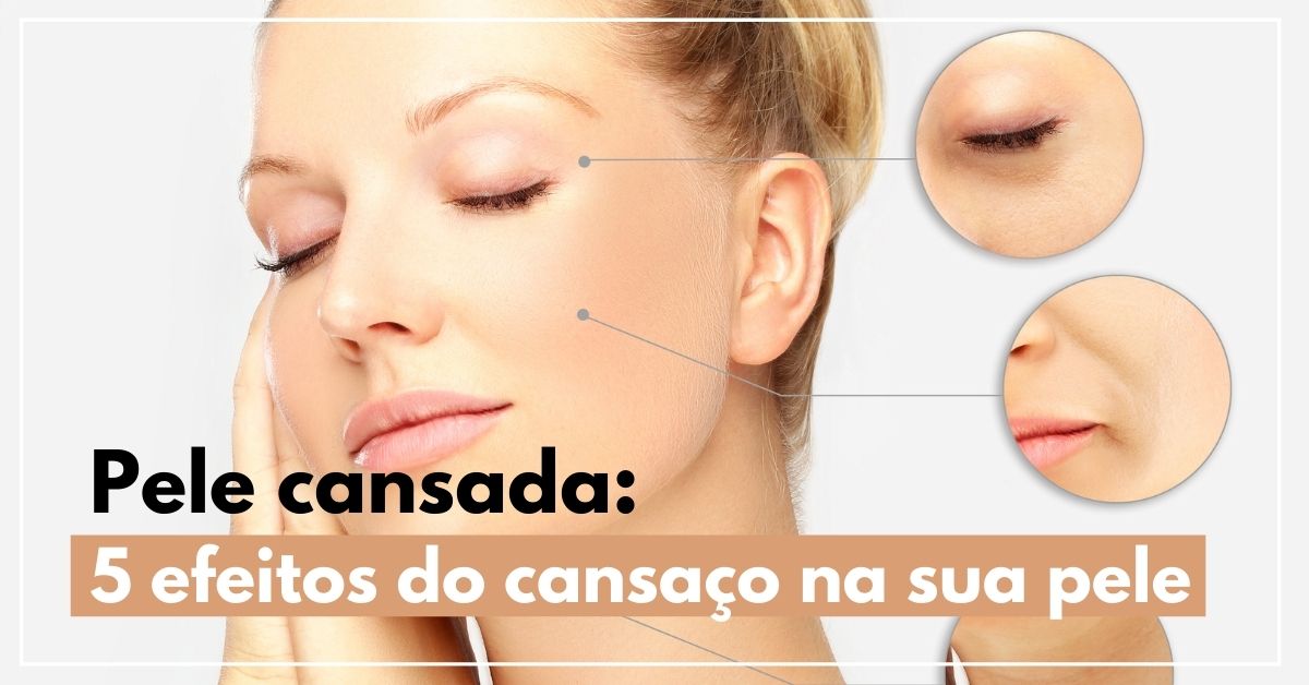 Pele Cansada 5 efeitos do cansaço na sua pele