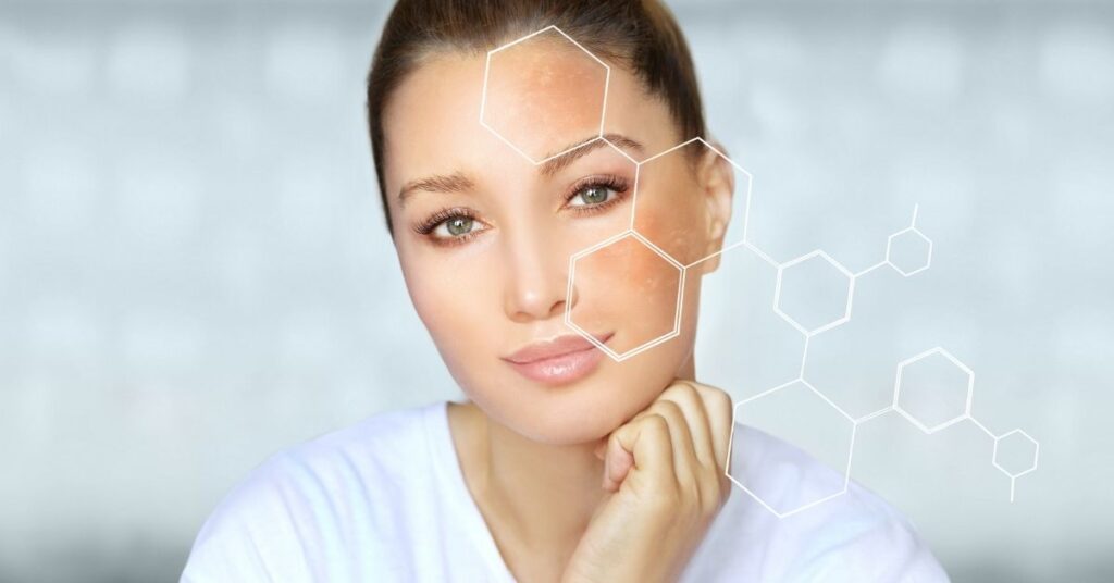 Manchas na pele de melasma tem cura?