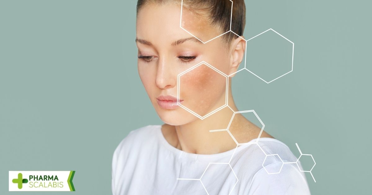 Manchas na pele de melasma tem cura?