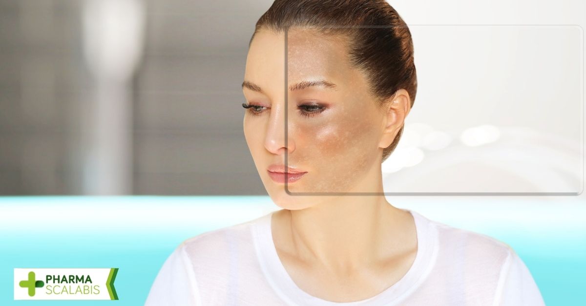Melasma, pecas, melanoma: 5 tipos de manchas que pueden aparecer con la exposición al sol