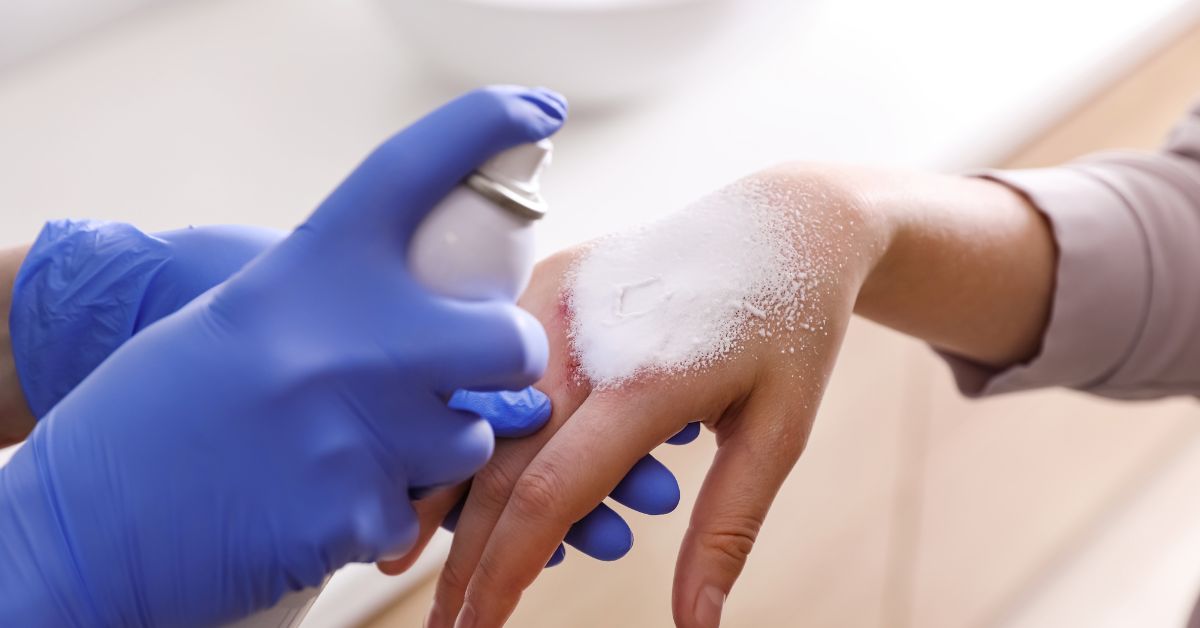 Queimaduras de Pele: Como Identificar, Prevenir e Tratar de Forma Rápida e Eficaz