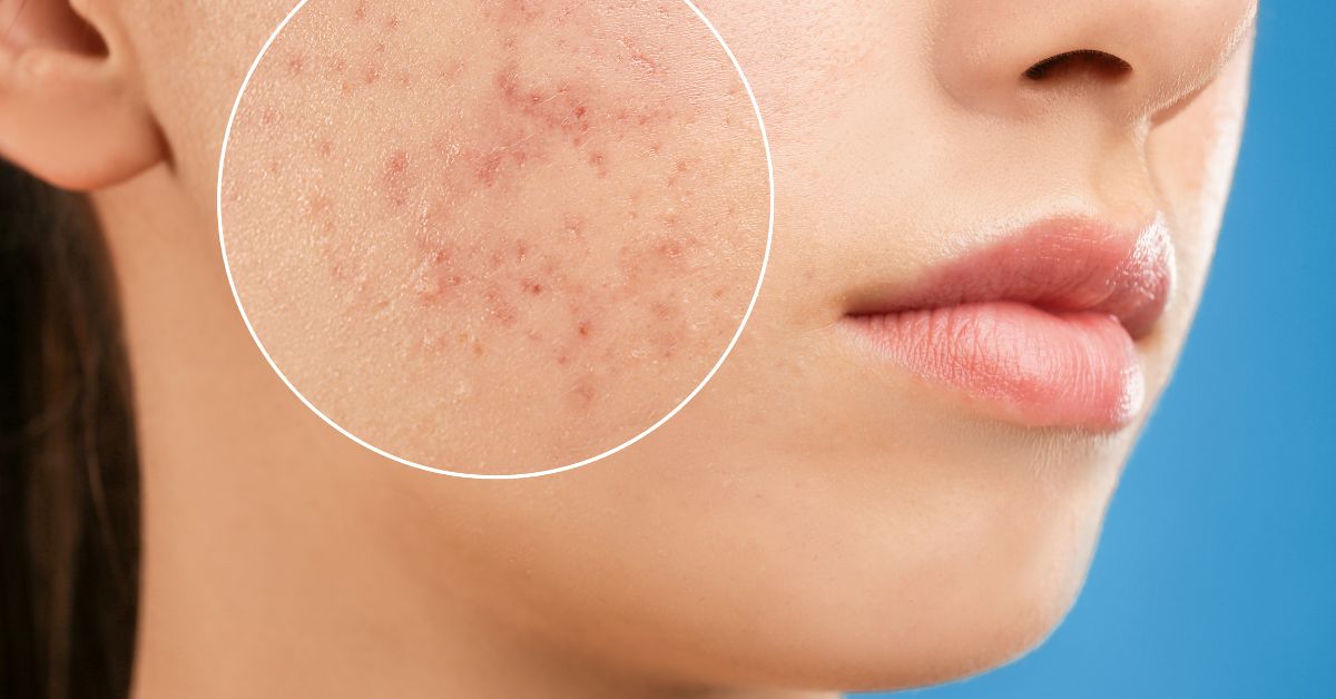 Acne Hormonal: Causas, Tratamentos e Prevenção