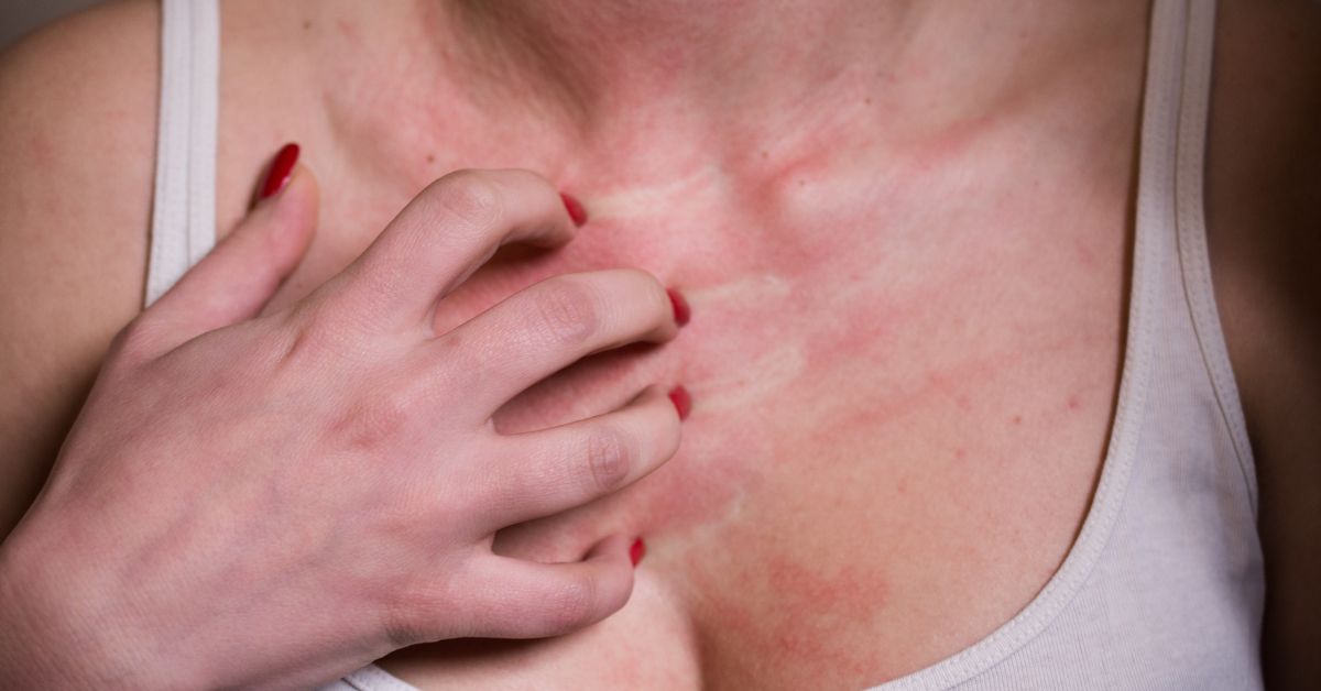 Alergia ao Sol: Sintomas, Causas e Como Lidar com a Situação