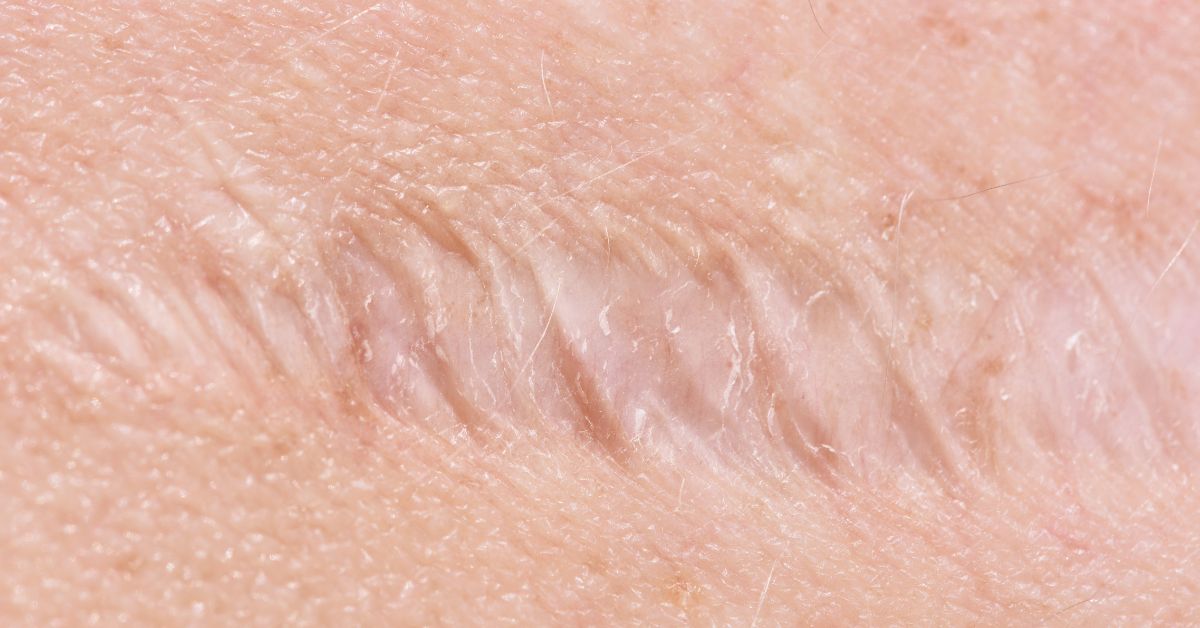 Como Otimizar a Cicatrização: Dicas e Cuidados Essenciais
