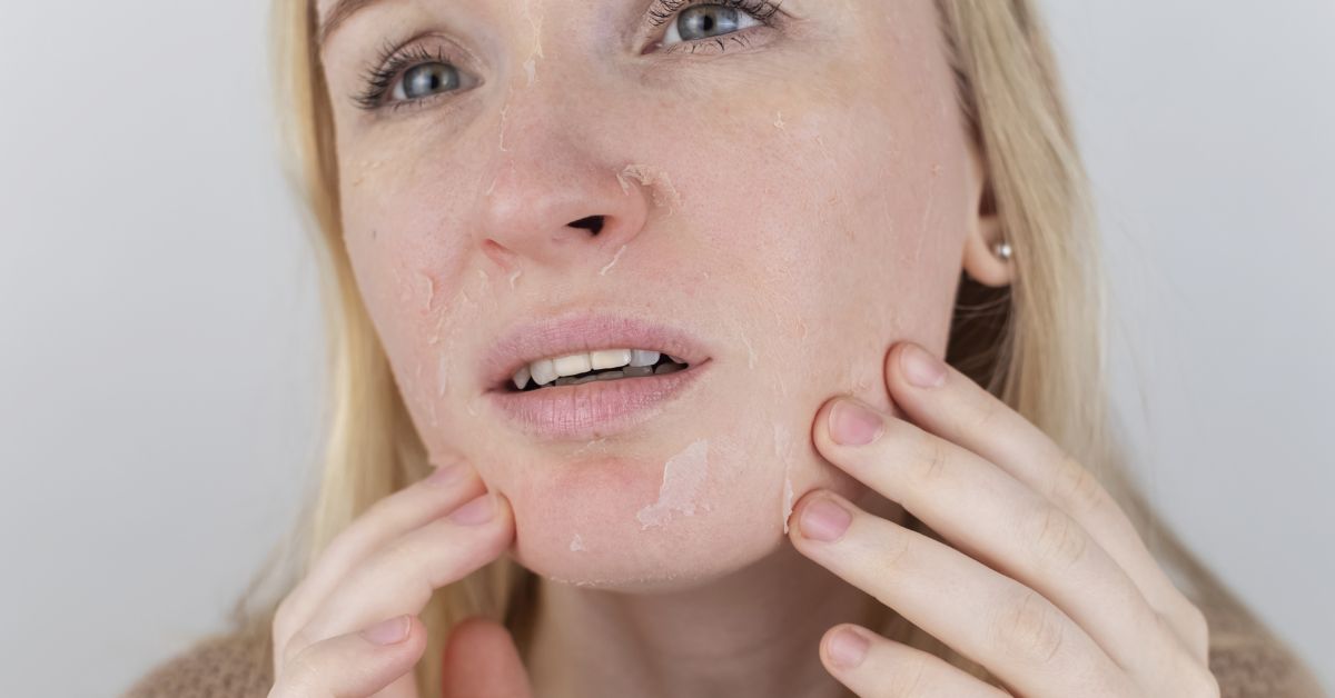 Pele Extremamente Seca: Como Tratá-la e Preveni-la