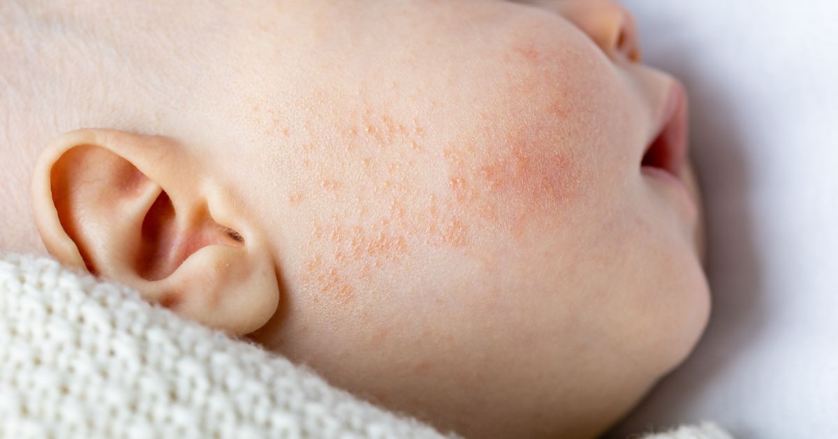 Manchas rojas en la piel: causas, tratamientos y prevención
