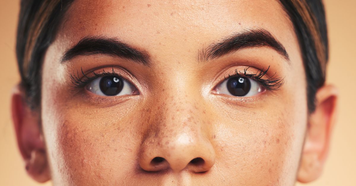 Melasma: Guia Completo para uma Pele Radiante