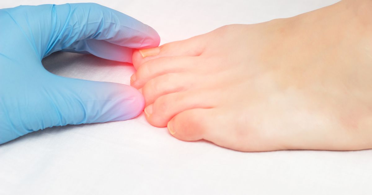 Combate Eficaz aos Fungos nas Unhas: Soluções e Cuidados