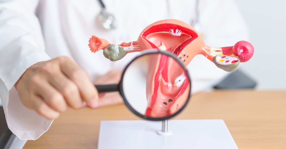 Endometriose: Sintomas e Tratamentos Disponíveis
